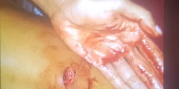 Joven ida hetan sona husi kotuk suku pontu 10 iha Baha Suku Foho Ailiku